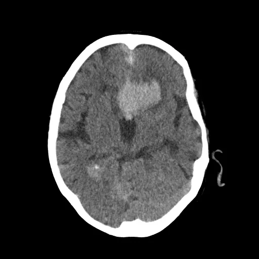 Raw CT Slice 2