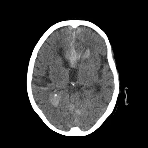 Raw CT Slice 3