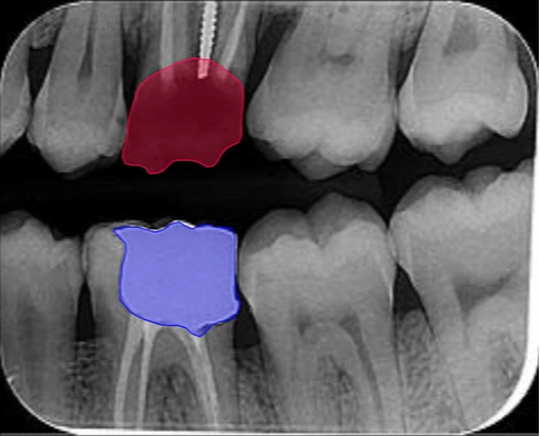 Dental AI Detections (After)